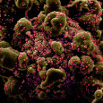 Новый коронавирус отличается резкой дихотомией течения и исхода болезни, очень лёгкое, почти бессимптомное и, наоборот, крайне тяжёлое, с плохой перспективой и разнообразными...